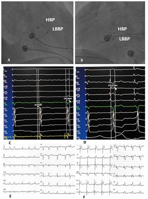 Therapeutic Effect of His-Purkinje System Pacing Proportion on Persistent Atrial Fibrillation Patients With Heart Failure